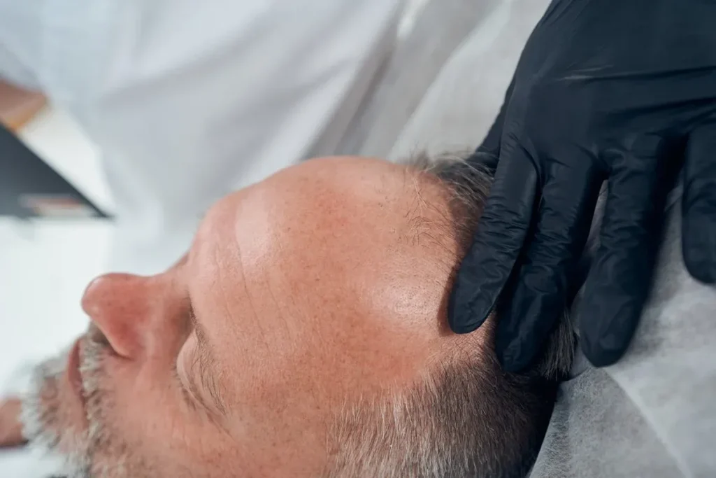 DHI vs FUE Hair Transplant: Understanding the Basics