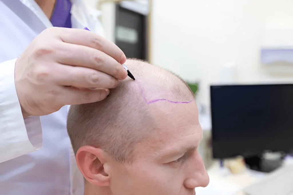 Direct Hair Implantation: Amazing Results