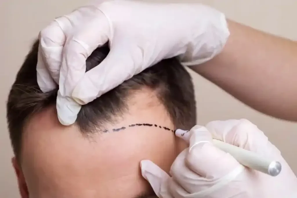 Do Donor Hairs Grow Back? Essential Info