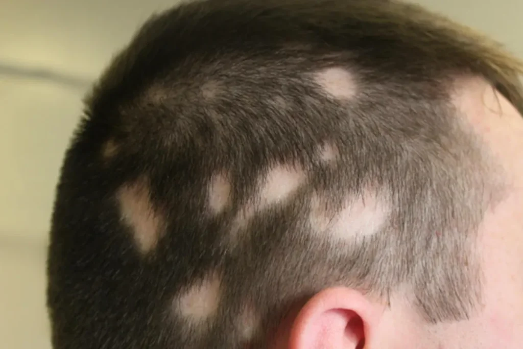 Does Alopecia Itch? Best Soothing Relief