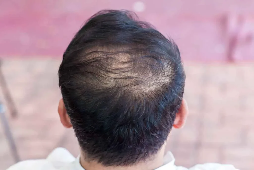 Does Diet Affect Hair Loss? Best Results