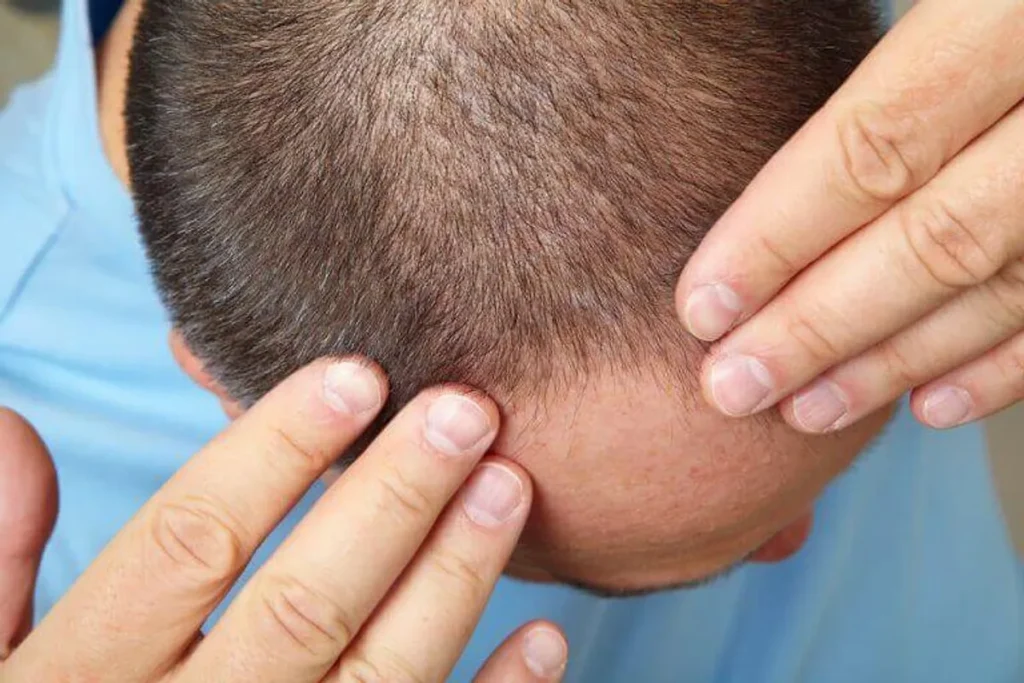 Understanding Finasteride's Mechanism of Action