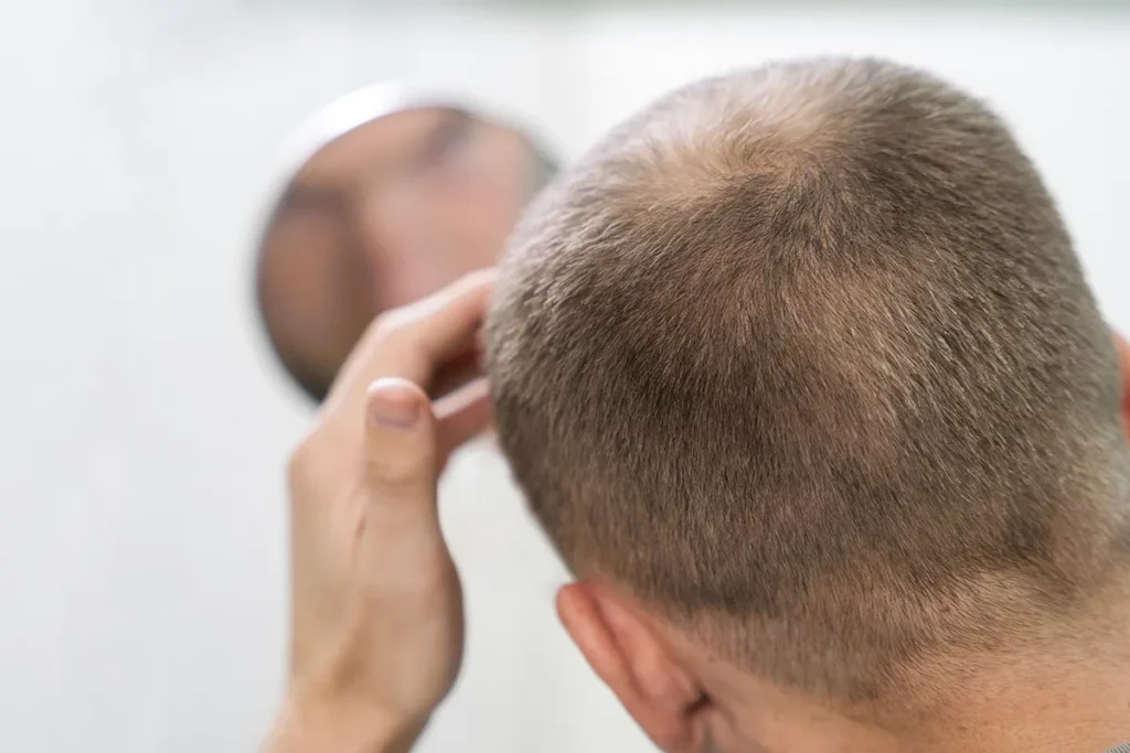 Does Finasteride Stop Hair Loss? Research Evidence