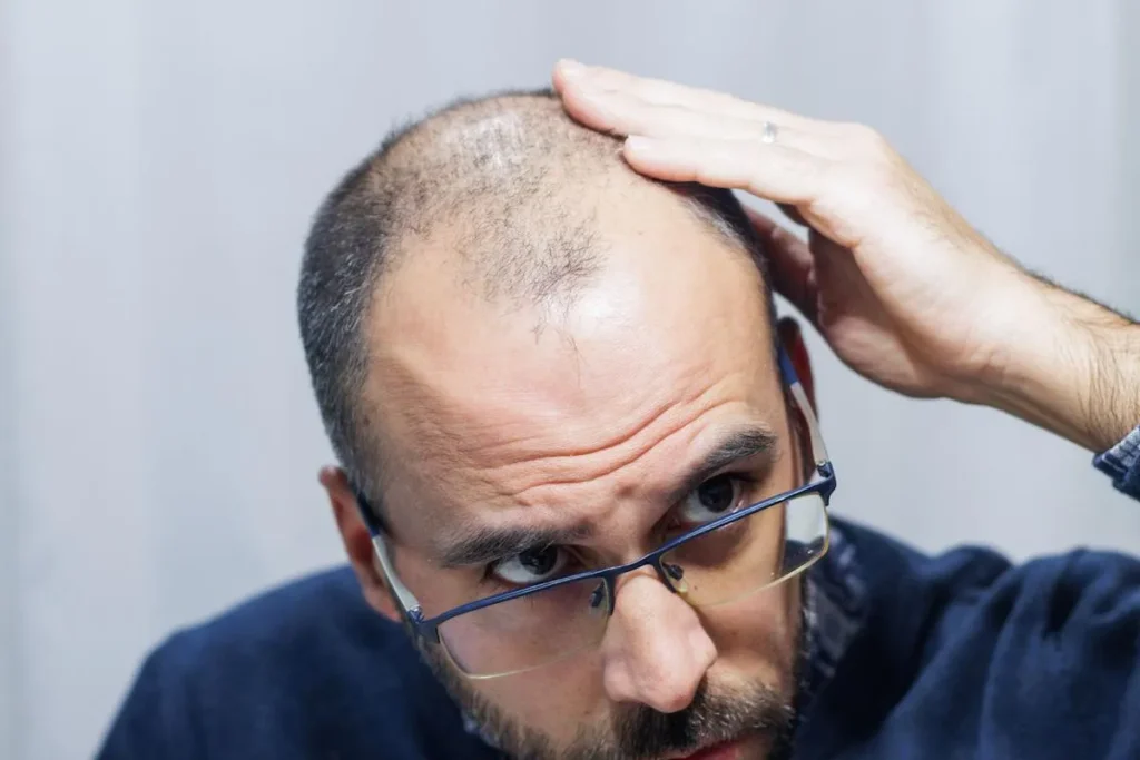 Does Finasteride Actually Work for Hair Loss?