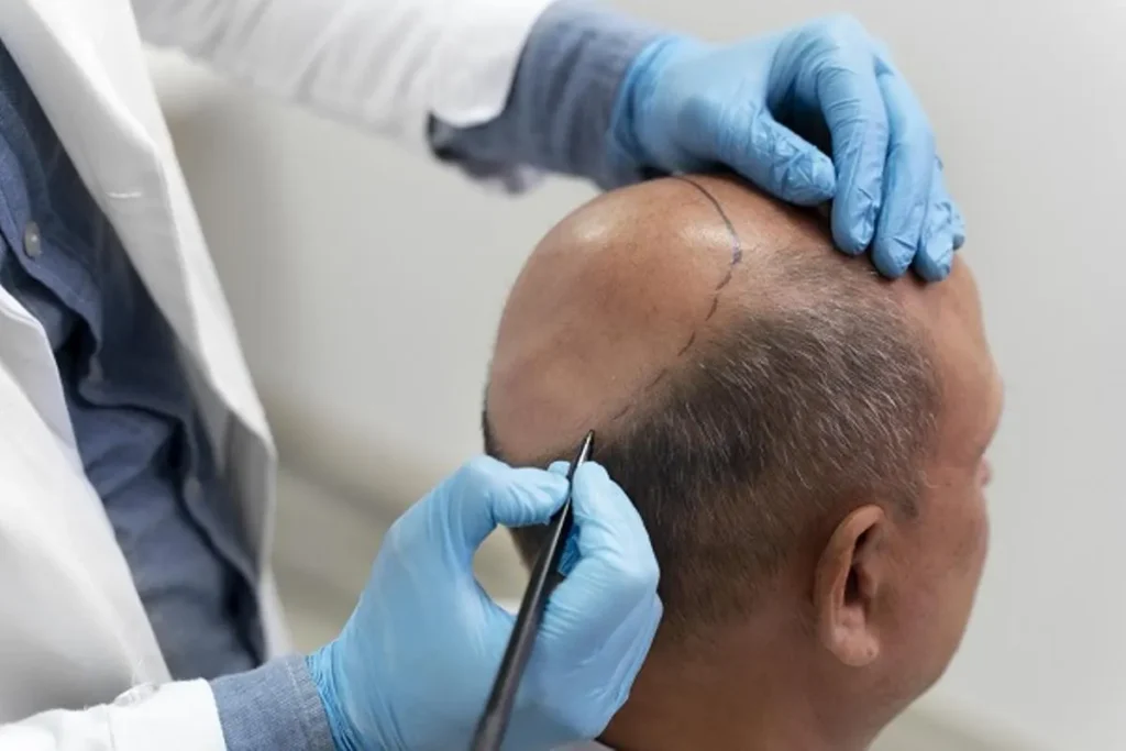 Does Hair Regrow in Donor Area After FUE?