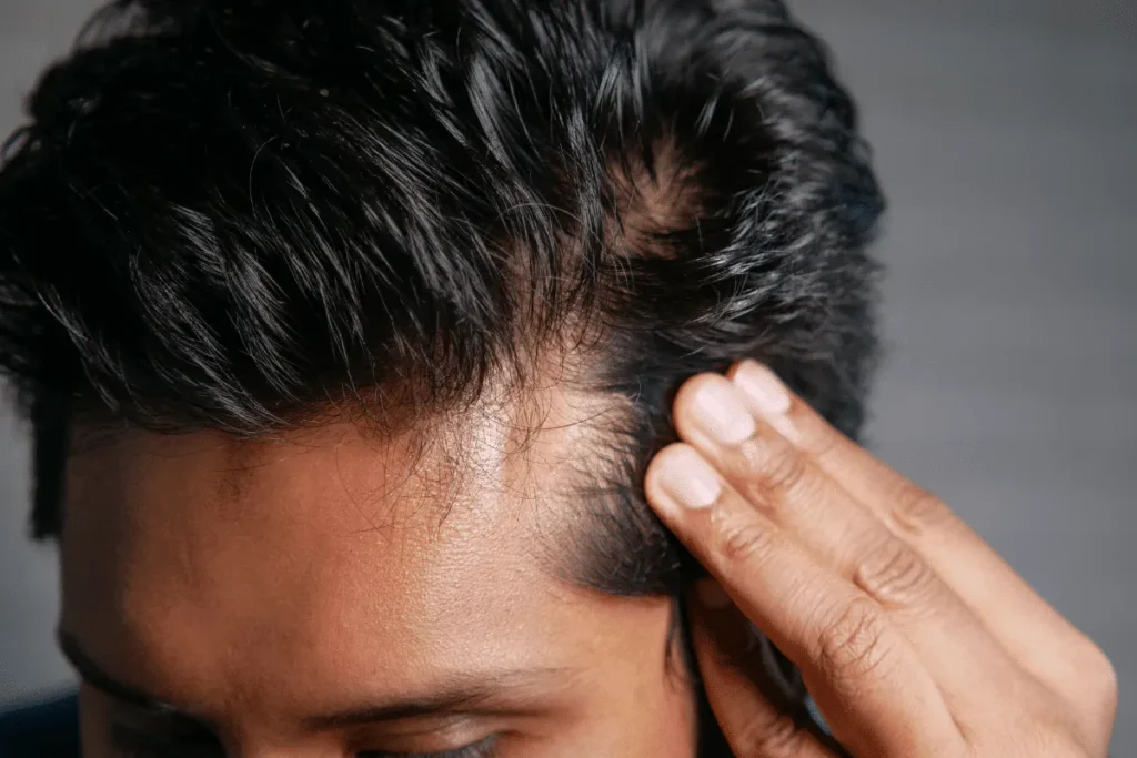 Does Laser Treatment Work For Hair Loss? Fix