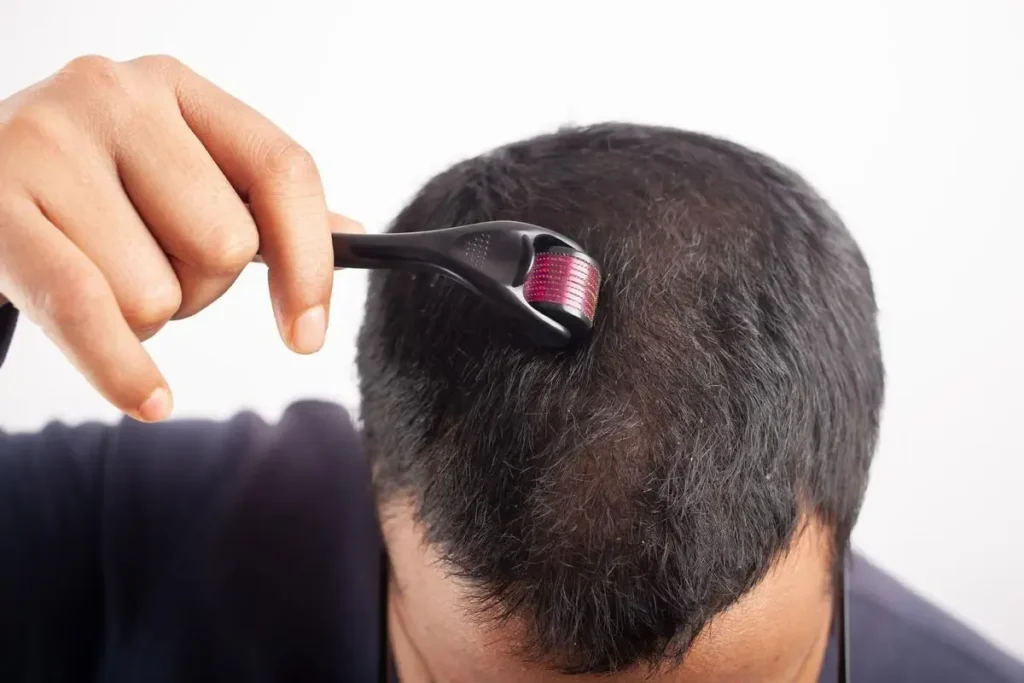 Does Nioxin Have Minoxidil? The Truth Revealed