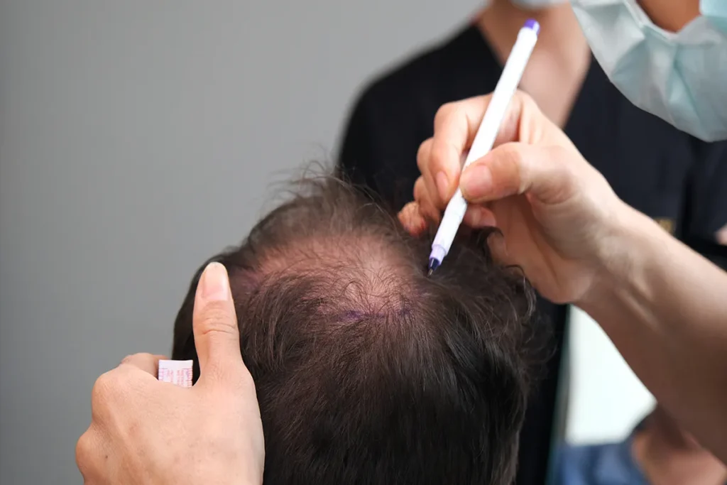 Understanding Hair Shedding vs. Hair Loss