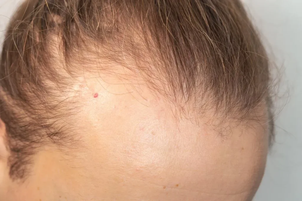 Early Receding Hairline: Best Warning Signs