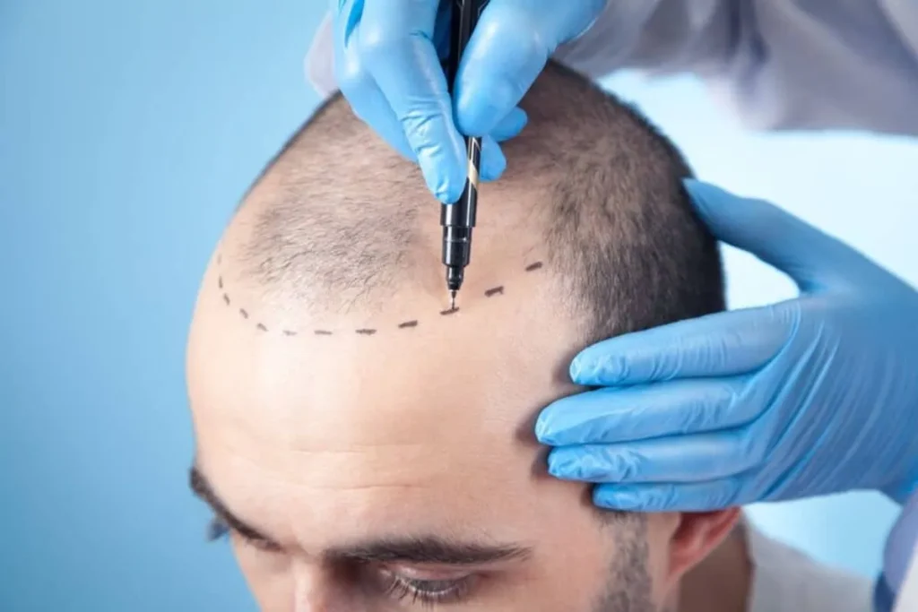 Identifying the Early Signs of a Receding Hairline