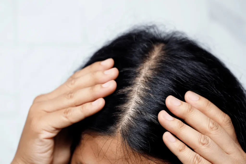 Female Pattern Baldness: Best Proven Cures