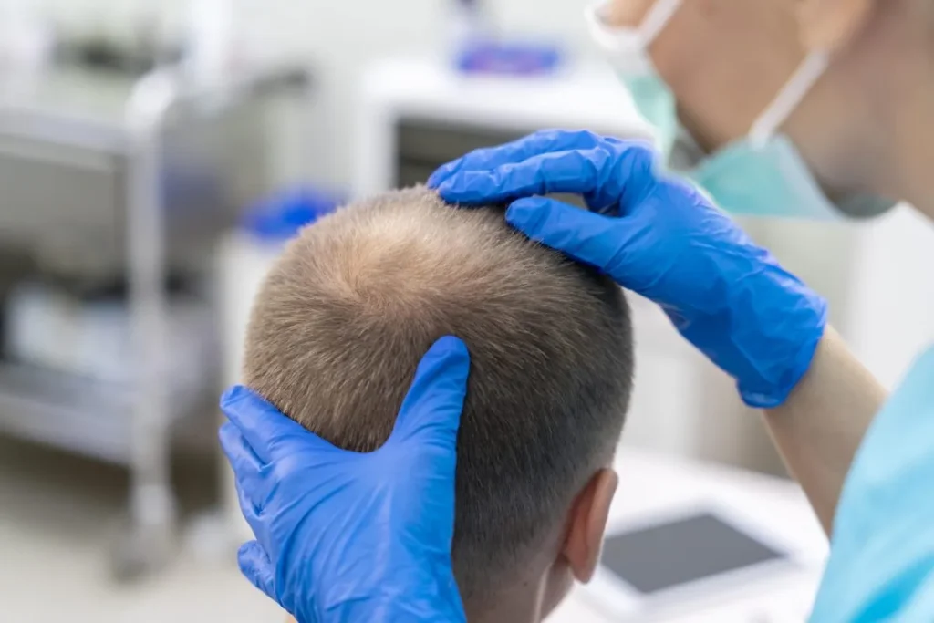 Follicular Unit Extraction Before And After