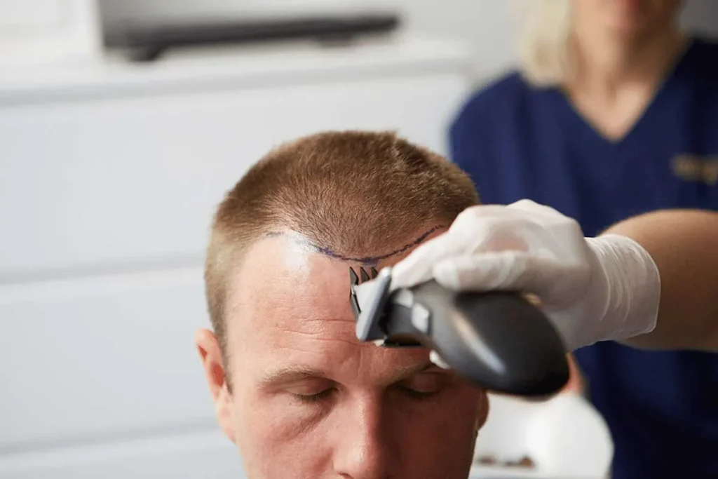 Follicular Unit Extraction Recovery: Tips
