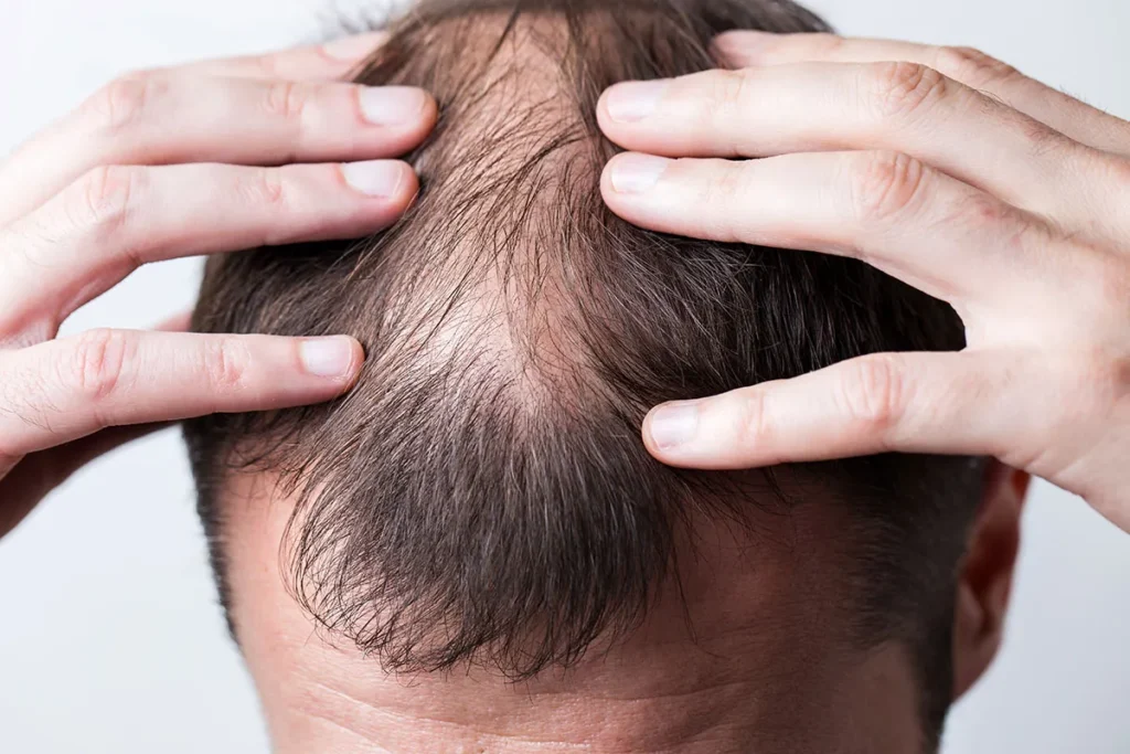 Food For Hair Loss: Best Nutrition Guide
