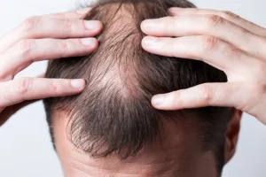 Food For Hair Loss: Best Nutrition Guide