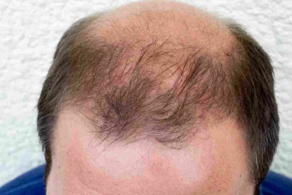 Frontal Female Pattern Baldness: Best Fix