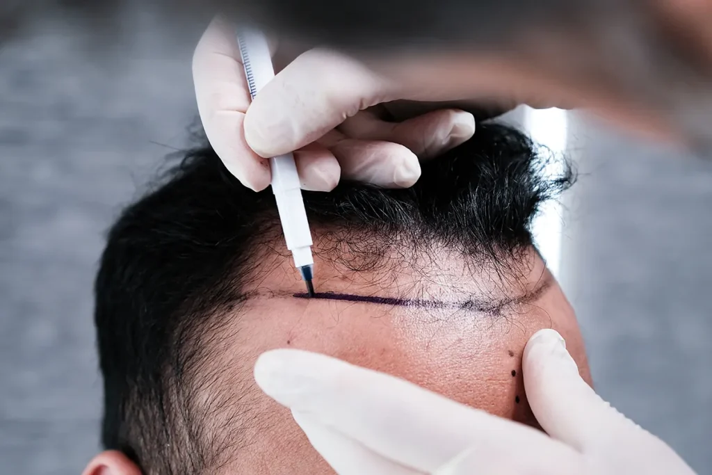 Illustration of a hair transplant session
