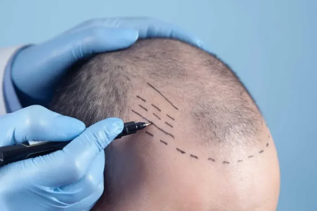Hair Graft Definition: Amazing Facts