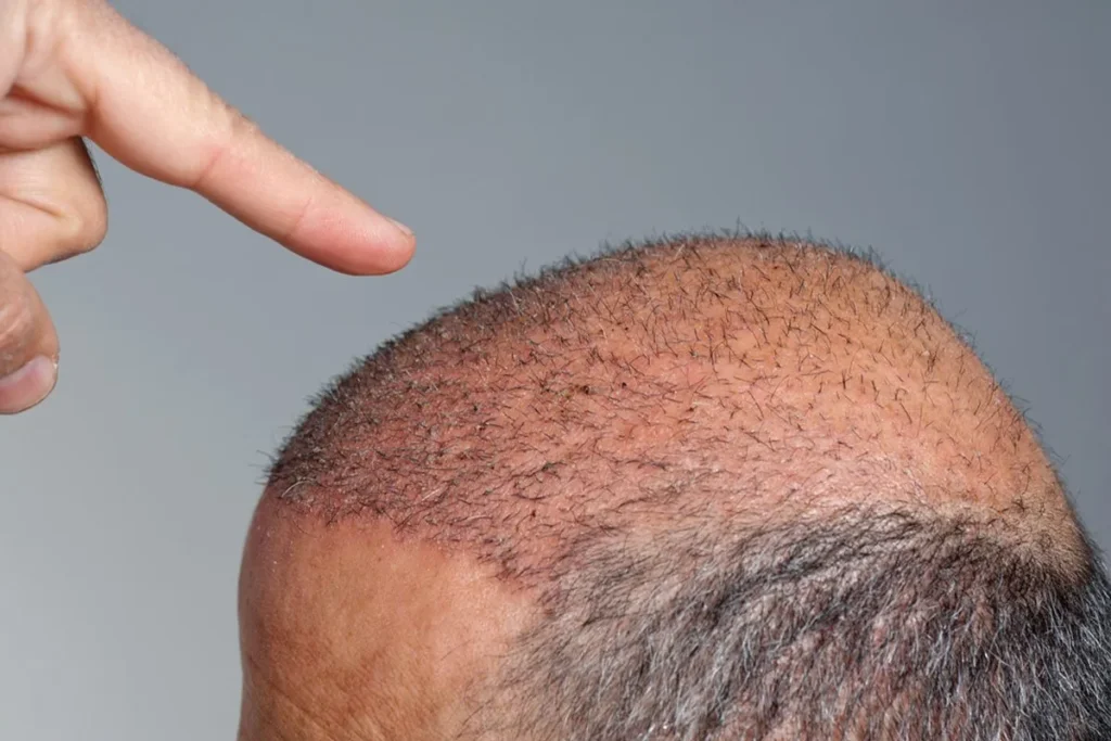 Hair Grafting Forehead: Amazing Results
