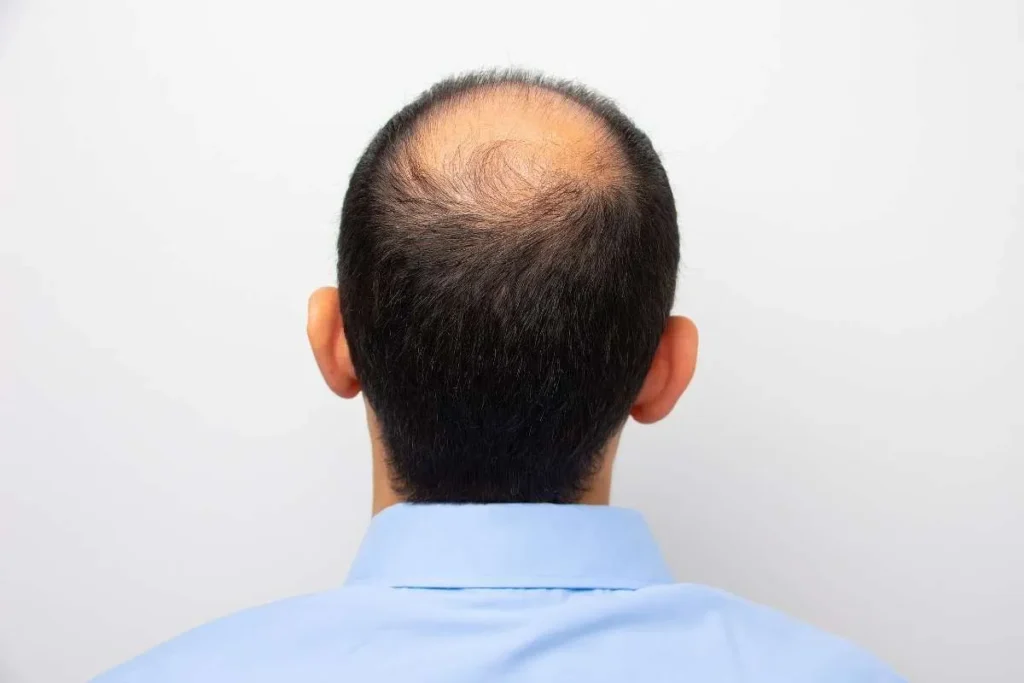 Hair Grow For Men: Best Proven Secrets