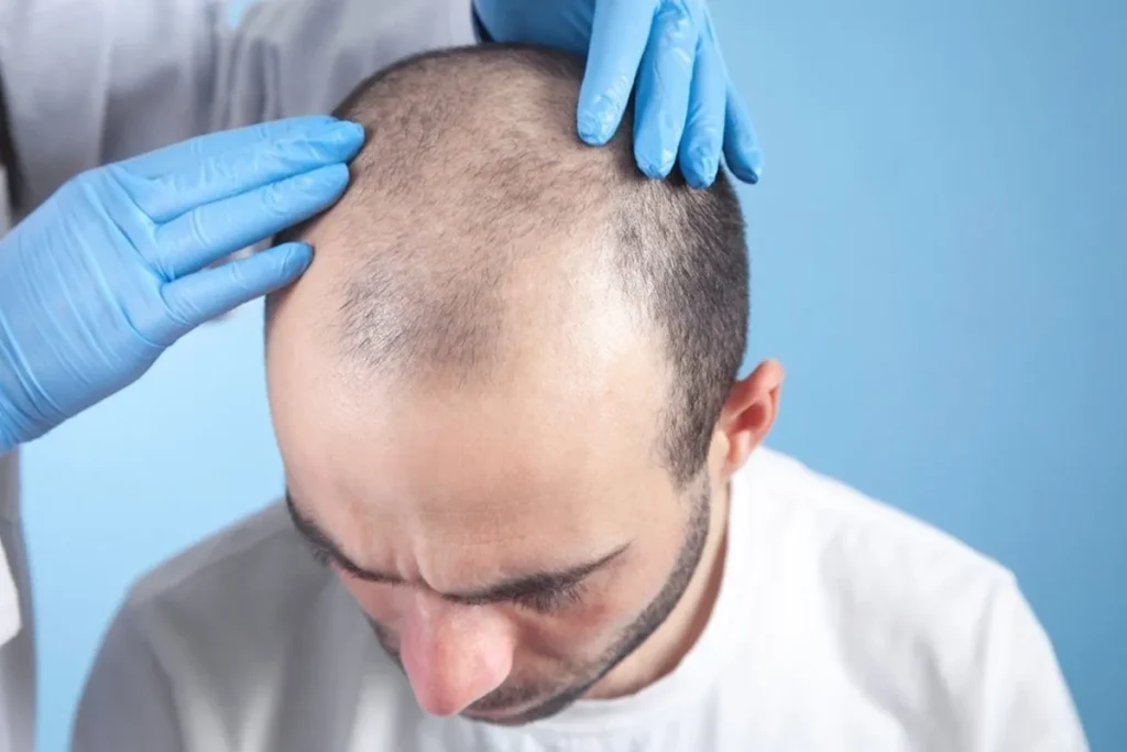 Understanding Hair Loss After Hair Transplant Surgery