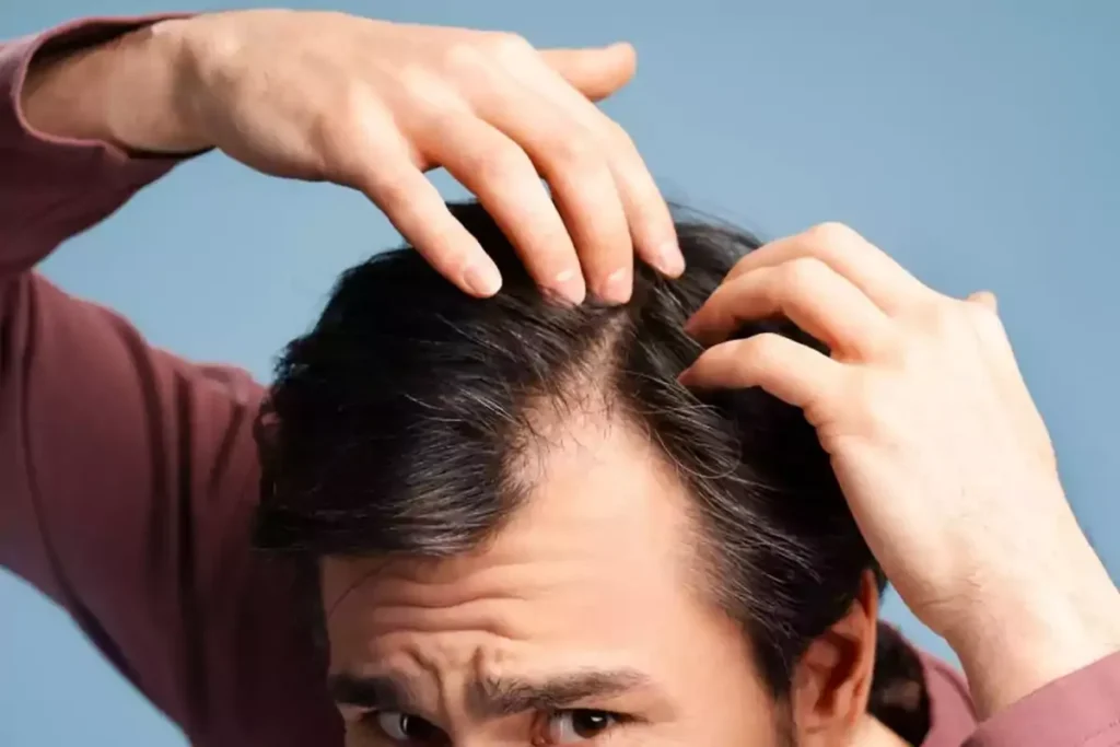 Haaruitval door medicijnen: Beste verlichting