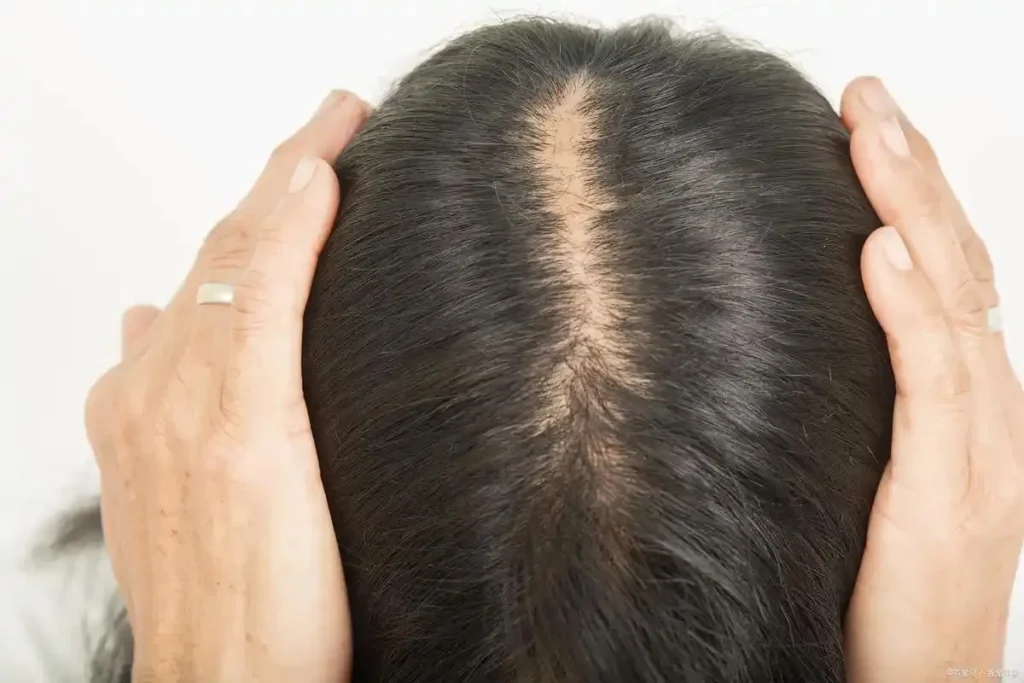 Hair Loss From One Side: Best Secrets