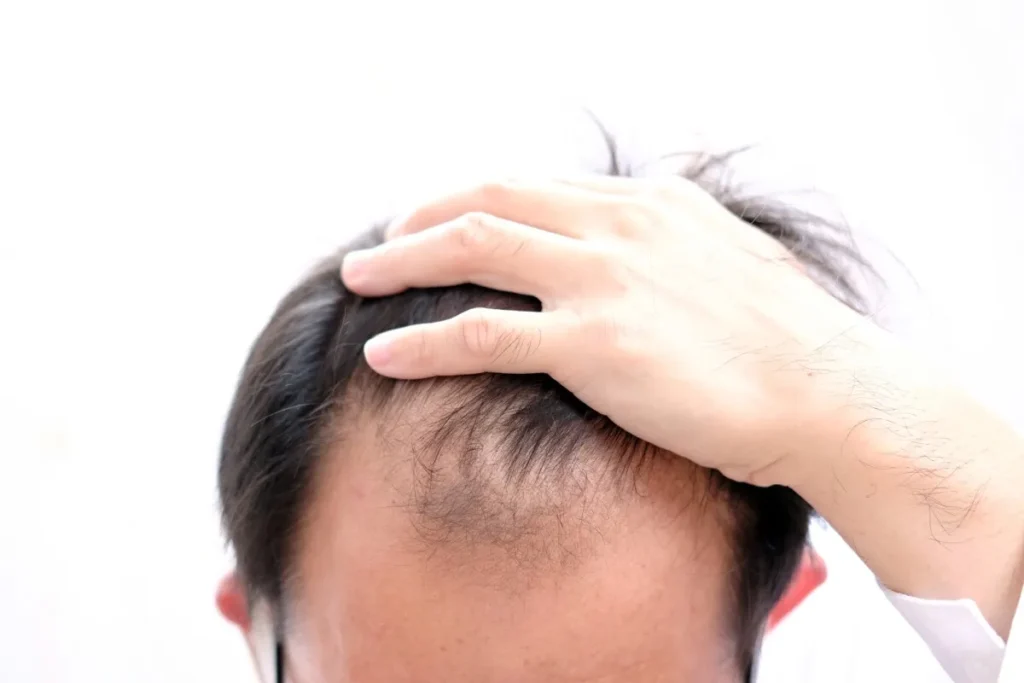 Hair Loss In Corner Of Forehead: Best Fix