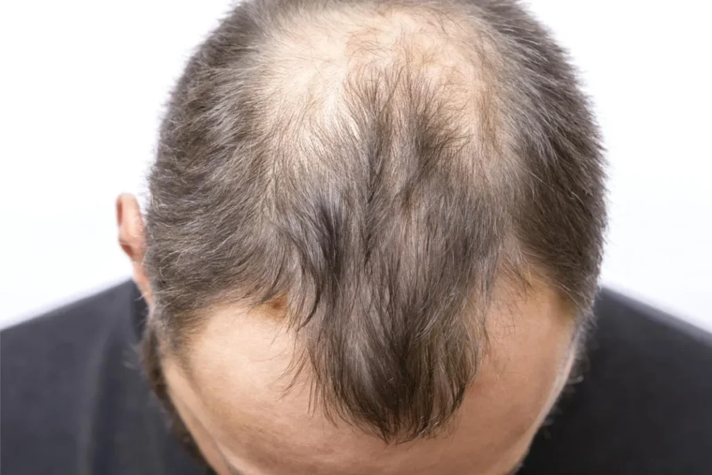 Hair Loss Over 50: Amazing Growth Guide