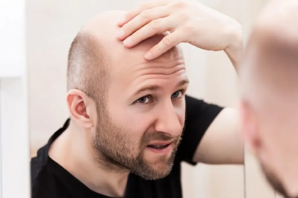 Hair Loss Temples Male: 7 Best Cures