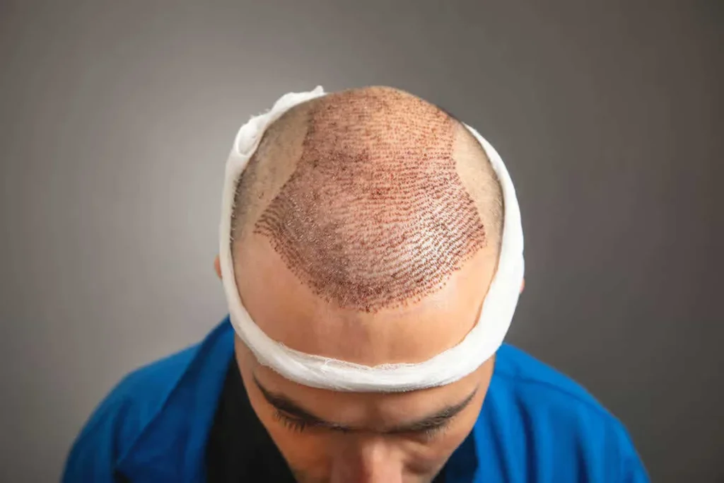 Hair System Vs Transplant: Best Choice