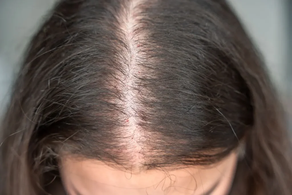 Hair Thinning At Corners: Best Wow Fix