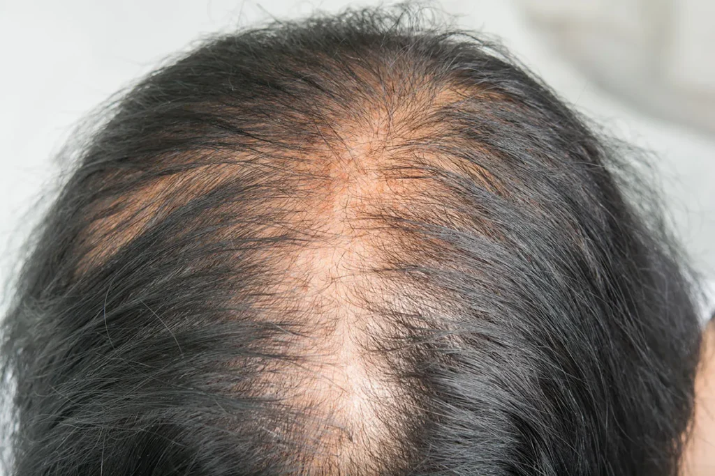 Causes of Hair Thinning at Crown Male