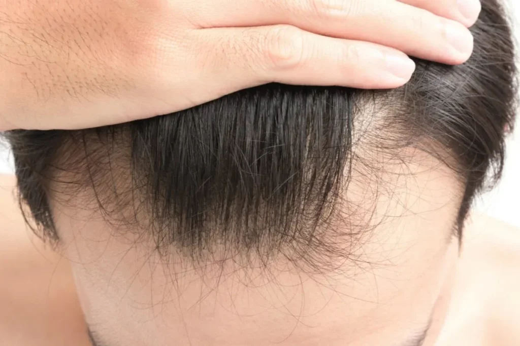 Effective Natural Solutions to Combat Hair Thinning