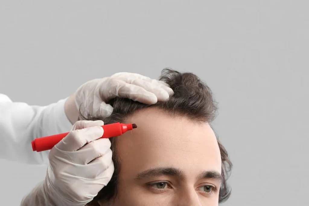 Hair Transplant After 1 Month: Best Tips