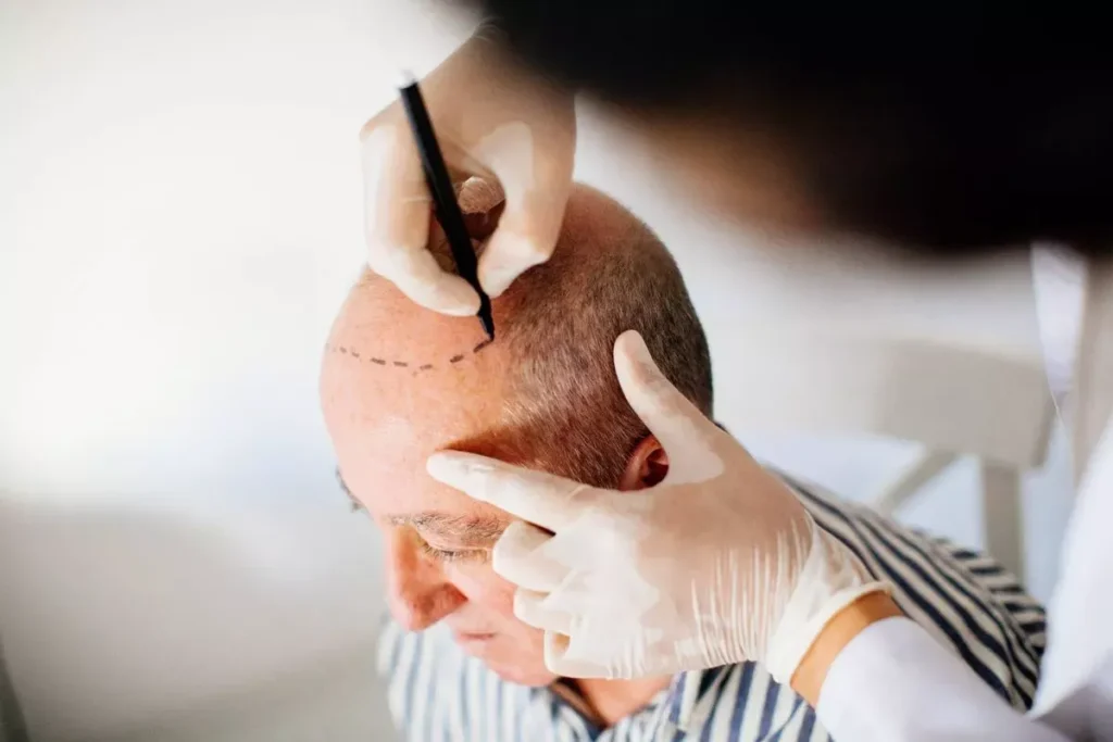 Hair Transplant After 2 Months: The Shock Loss Phase