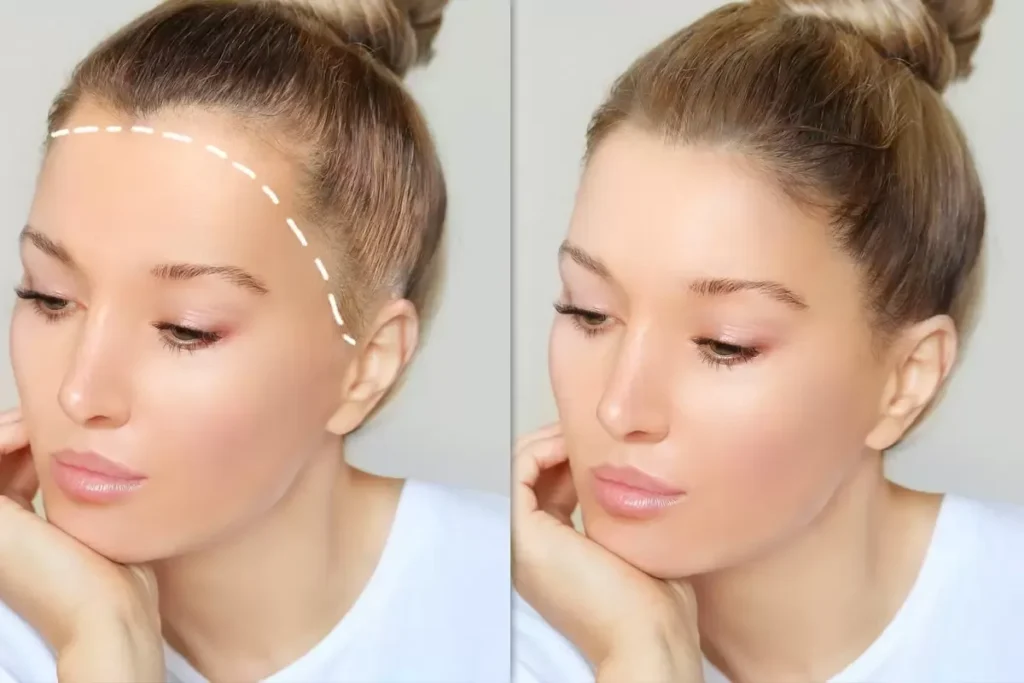 Hair Transplant Female Hairline: Best Fix
