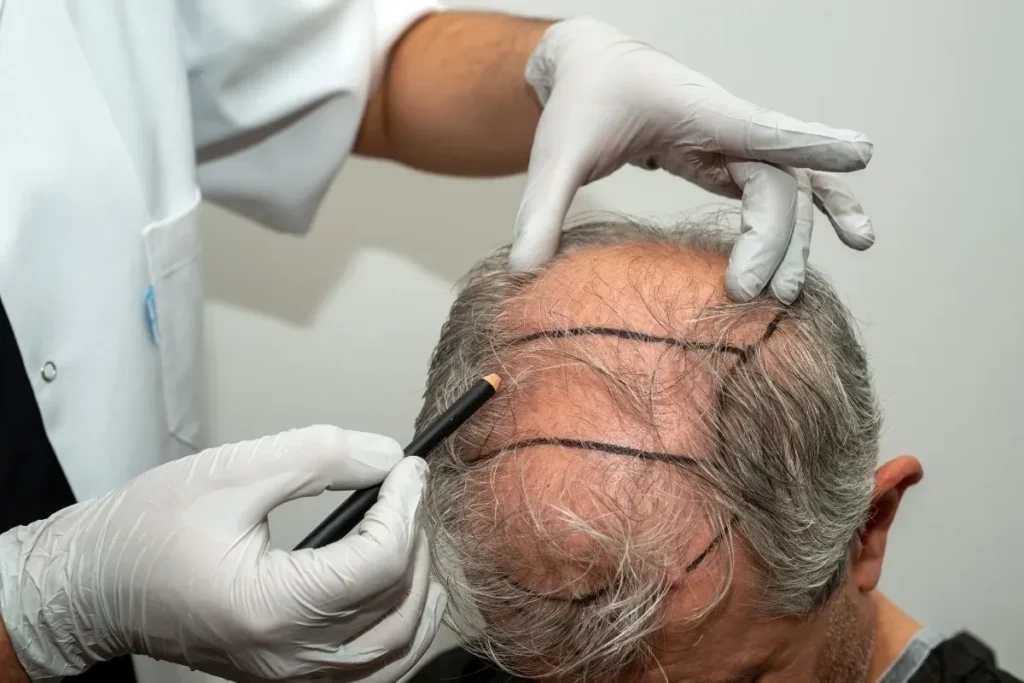 Hair Transplant Hair Growth Timeline: Wow