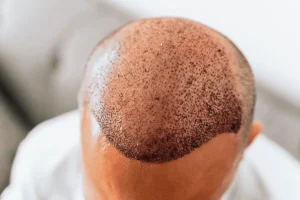 Common Medical Causes of Sudden Hair Loss