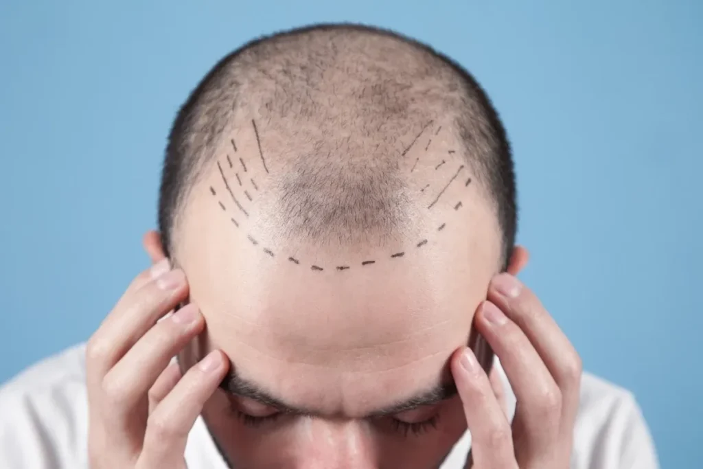 Hair Transplant Scabs Not Falling Off?