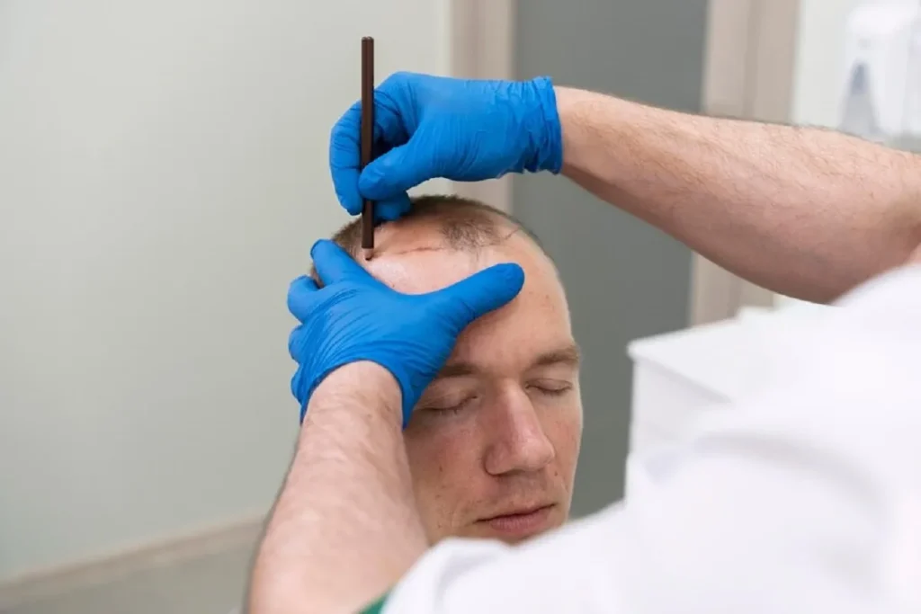 The Hair Transplant Growth Timeline