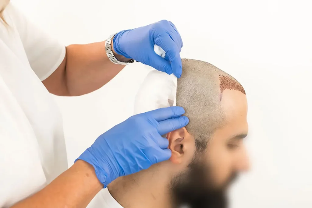 The Growing Demand for Hair Transplant Surgeons