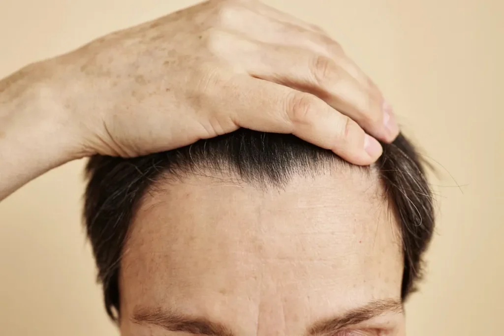 Understanding Hairline Lowering and Its Benefits
