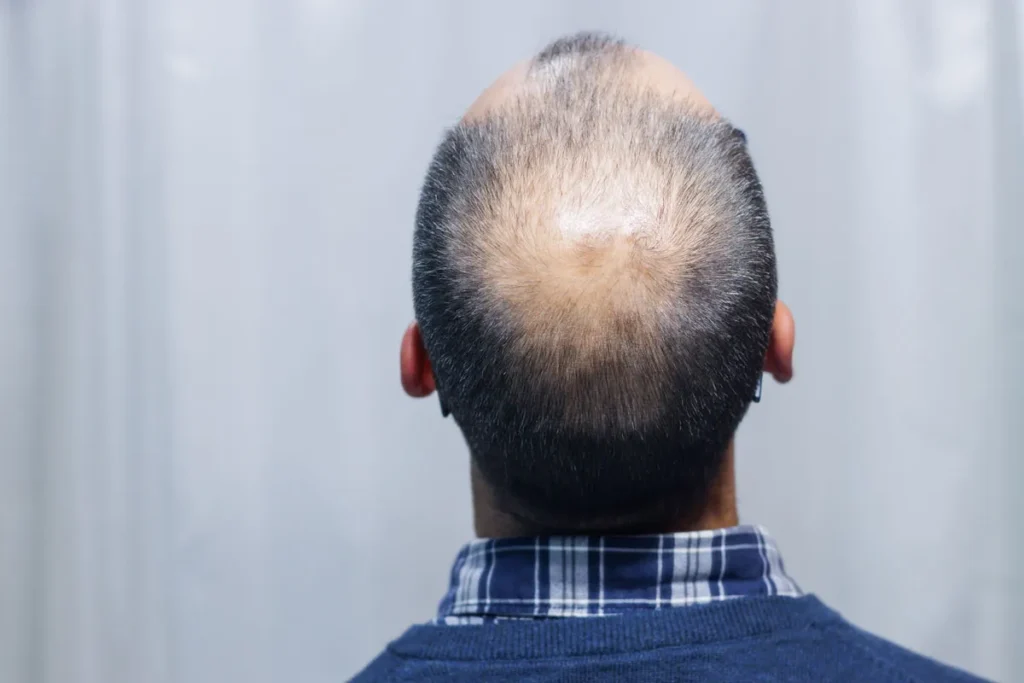 How Can You Tell If You Have Alopecia? Guide