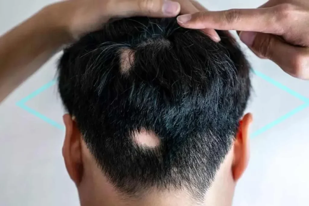 How Common Is Alopecia Areata? Shocking Truth