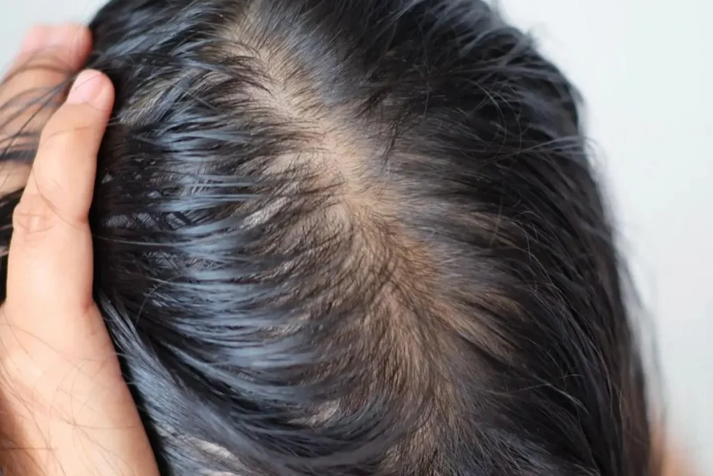 Hoe werkt dunner wordend haar? Ongelooflijke feiten