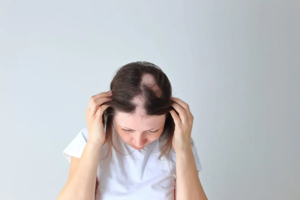 How Long Does Alopecia Areata Last? Success