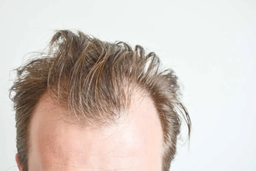 How To Combat Hair Loss From Stress: Easy