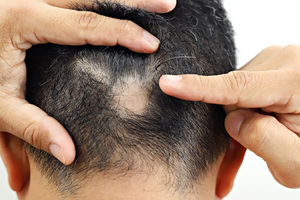 How To Fix Bald Spots: Powerful Results