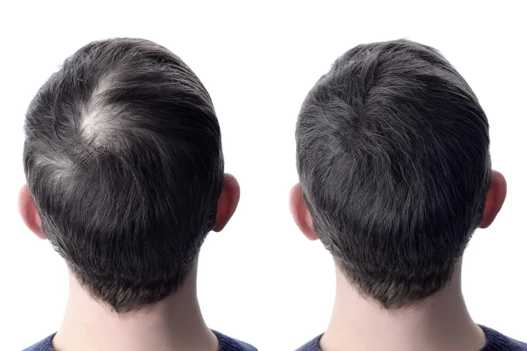 How To Fix Bald Spots: Powerful Results